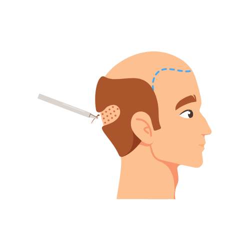 FUE and DHI Hair Transplant - Q Care